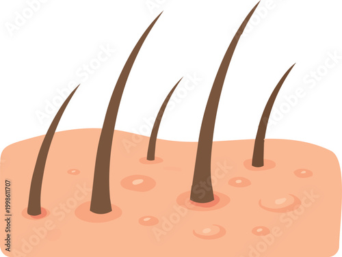 Illustration of human scalp showing symptoms of seborrheic dermatitis, including oily patches and irritation around the hair follicles.