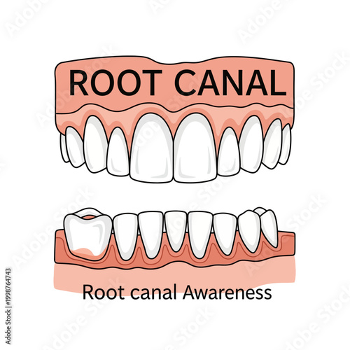 Dental illustration showing upper and lower teeth with root canal awareness.