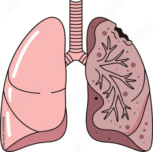 An educational illustration contrasting a healthy human lung on one side with a diseased, damaged lung on the other, depicting the impact of illness.
