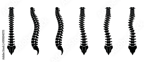 Human Spine Anatomy Vector Set, Spinal Column Deformities, Scoliosis, Kyphosis, and Lordosis Curves, Medical Icons for Orthopedic Diagnosis, Chiropractic Treatment Education, Isolated Black Silhouette