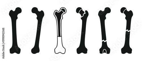 Human Femur Bone Fracture Set - Medical Orthopedic Illustration of Leg Bone Injuries and Anatomical Health Conditions for Clinical Educational Diagrams, Surgery Planning and Radiology Diagnostic Analy