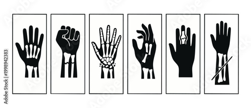 Broken Hand Bone Fractures Set, Orthopedic Injury Medical Icons Illustration depicting various hand and wrist skeletal traumas including finger fractures and radius breaks in black and white infograph