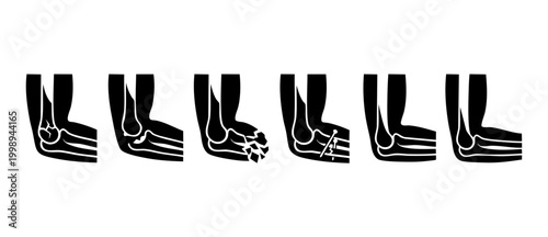 Bone Fracture Types Elbow Injury Set - Medical X-ray Style Illustrations Showing Human Joint Damage, Trauma Stages, Orthopedic Surgery Fixation, and Healthy Anatomy Diagrams for Healthcare Education