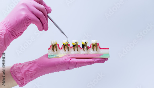 Dentist holding a periodontal disease model. Stages of gingivitis, periodontitis, and bone loss anatomy concept.