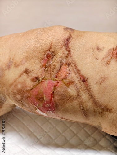 Close-up of a second-degree thermal burn caused by scalding hot water. The image shows skin redness, damaged tissue, and a healing scar on the knee area. Ideal for medical and first aid education.