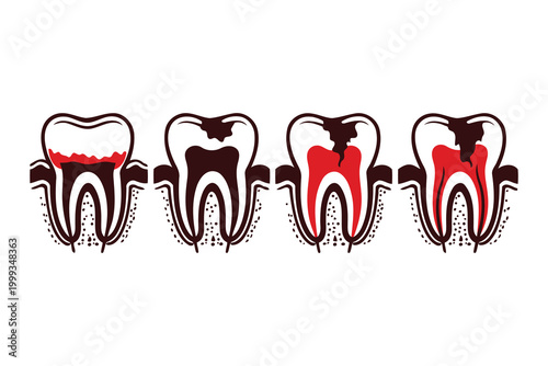 Illustration of tooth decay stages from healthy to severely damaged Vector