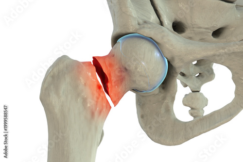Displaced femoral neck fracture, 3D illustration.