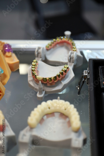 implante dental y coronas dentales de oro para tratamiento dental