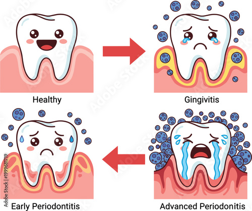 Vector illustration of teeth showing stages of gum health from healthy to gingivitis and periodontitis