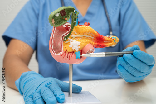 Pancreatitis, pancreatic cancer, Asian doctor with pancreas, gallbladder and bile duct human anatomy model at hospital.