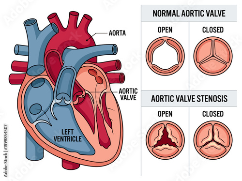 Medical Diagram of Aortic Valve Stenosis vs. Normal Heart Valve Function