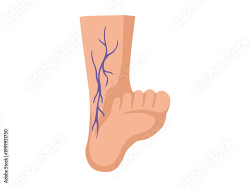 Hand Drawn Varicose Veins Foot 
