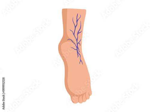 Hand Drawn Varicose Veins Foot 
