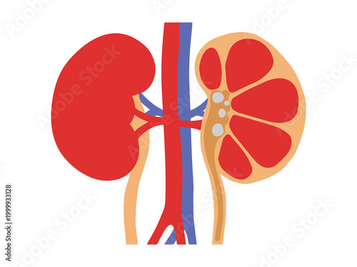 Human Kidney Stones Disease Illustration