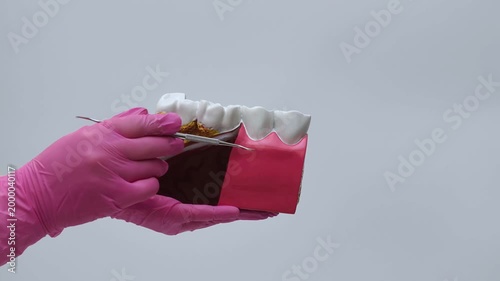 Dentist in Pink Gloves Pointing at Periodontal Disease and Tartar on Teeth Model
