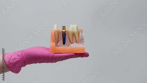 Hands Presenting Dental Implant Cross Section Model