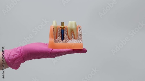 Dental bridge placement on implant and natural teeth anatomical model