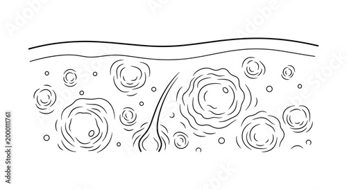 Illustration of skin with hives showing raised circular welts in a monochrome line drawing style on a white background