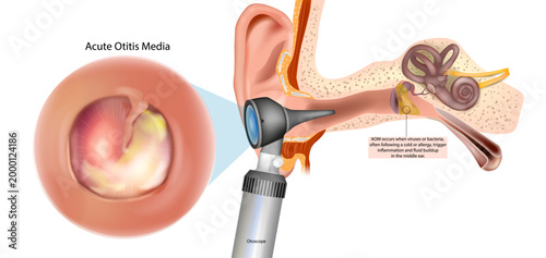 Acute Otitis Media Medical Illustration with Otoscope Ear Examination and Middle Ear Infection Anatomy. Acute Otitis Media Anatomy Infographic with Eardrum Inflammation Fluid and Inner Ear Structure