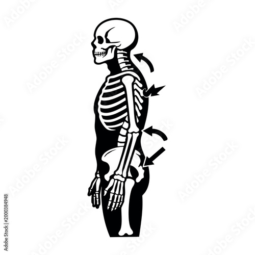 Human skeleton illustration showing cervical kyphosis, thoracic kyphosis, and lumbar lordosis, indicating poor posture and spinal issues