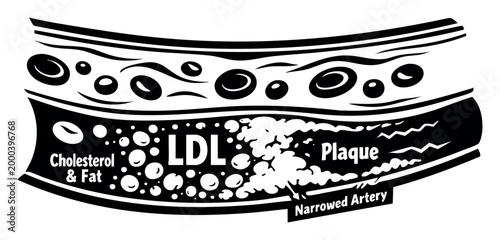 Artery showing cholesterol, fat, LDL, and plaque buildup, leading to a narrowed vessel and restricted blood flow