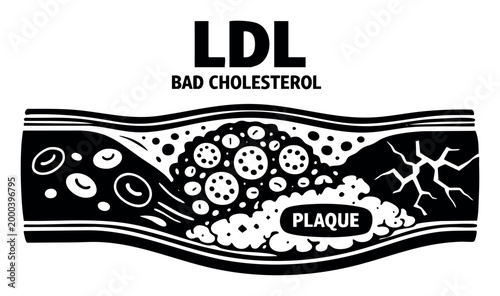 LDL bad cholesterol increasing plaque in an artery, leading to atherosclerosis, artery narrowing, and heart disease