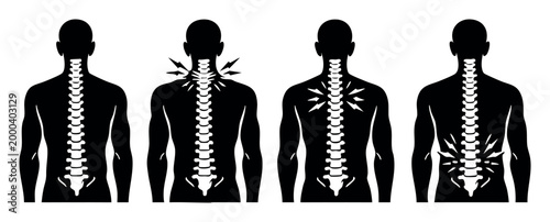 Human silhouettes illustrating different areas of spinal pain, showing healthy back and specific areas of discomfort