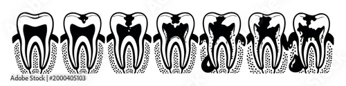 Tooth decay progression illustration showing enamel erosion, dentin damage, pulp infection, and abscess formation in a molar
