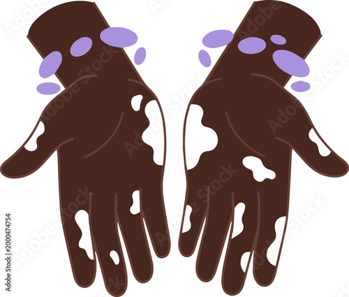 Vitiligo hands showing skin depigmentation on dark skin tone isolated for healthcare and diversity illustration