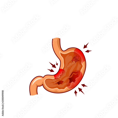 Stomach Ulcer Illustration, Gastric Ulcer Concept, Digestive System Problem, Stomach Pain and Internal Wound Condition