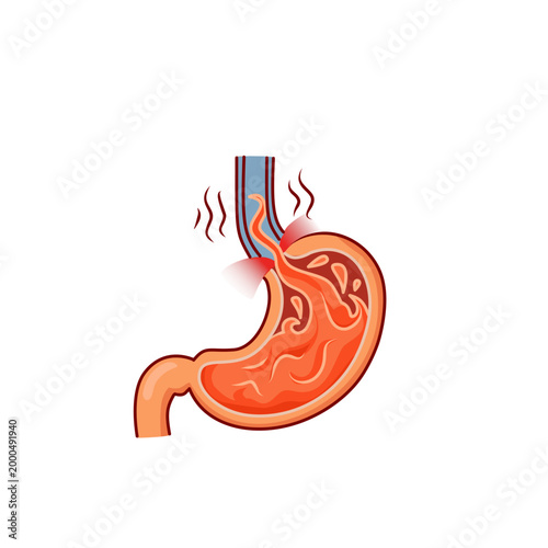 Gastroesophageal Reflux Disease Illustration, Acid Reflux and Heartburn Concept, Stomach Pain and Digestive System Problem