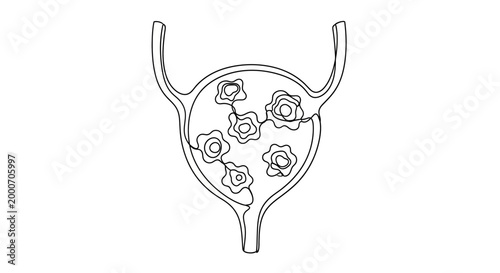 Illustration of the urinary bladder with kidney stones inside, depicted in a continuous line art style, representing a medical condition
