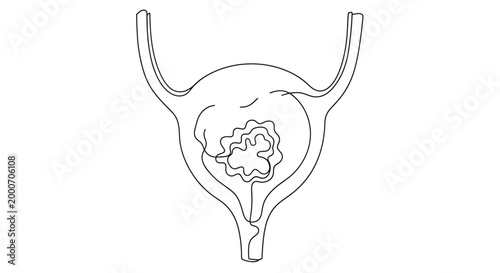 An anatomical illustration in continuous line art style depicts the human bladder with internal structures, likely representing a medical condition or internal anatomy