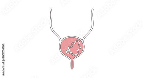 Continous line art illustration of a bladder with an internal growth, representing medical conditions or a health concern, rendered in a simple, elegant style on a white background for clarity