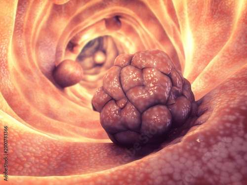 Abnormal cell clusters on the mucosal lining of the large intestine. Most polyps stay harmless, yet others progress from benign states to invasive tumors.