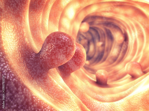 Benign tissue growths along the intestinal wall. While many bowel polyps are harmless, specific clusters can mutate and develop into malignant colon cancer.