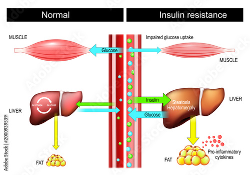 Insulin resistance. Insulin and Glucose Balance. Liver, Muscles and hyperinsulinemia.