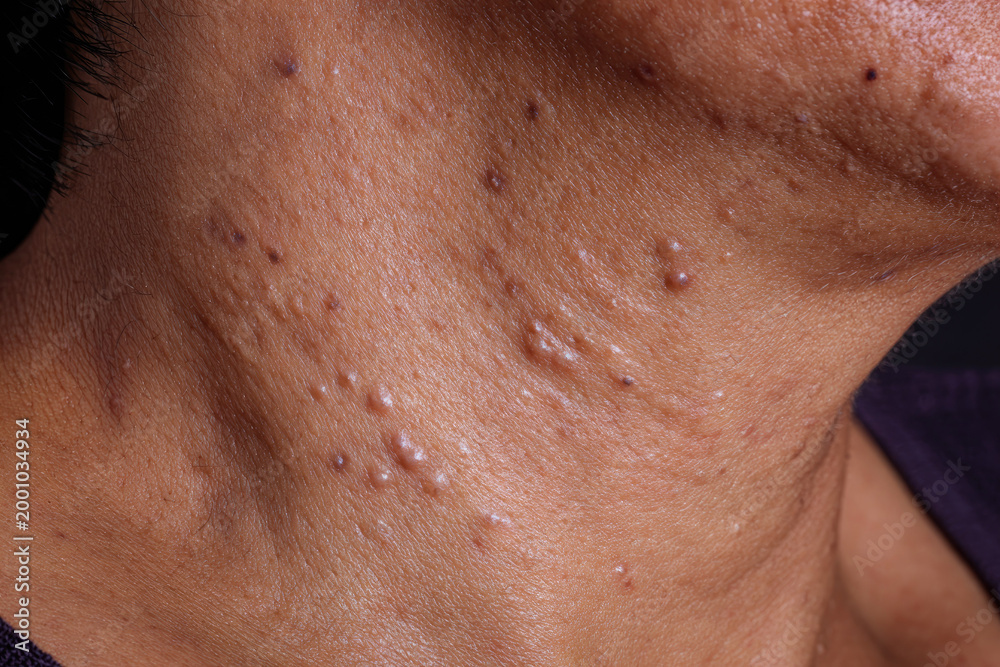 Naklejka premium Acne skin neck macro closeup dermatology blemish pimple texture health medical adult problem inflamed irritated spot scar epidermis complexion care human face detail imperfection unhealthy disease