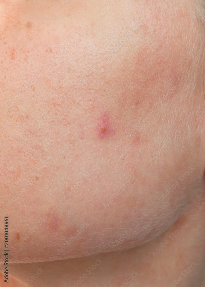 Fototapeta premium close up of a caucasian young woman's skin showing pores and blemishes 