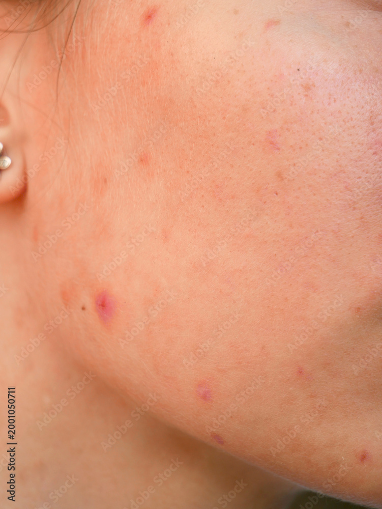 Fototapeta premium close up of a caucasian young woman's skin showing pores and blemishes 
