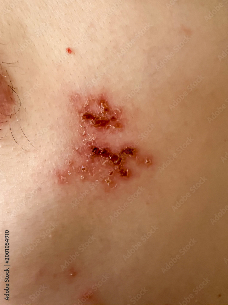 Fototapeta premium Close-Up of Herpes Zoster Rash on Skin – Shingles Dermatology Medical Condition