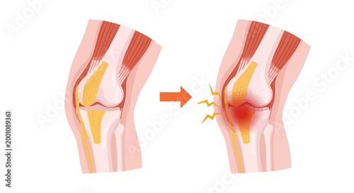 Knee Pain and Arthritis Illustration Comparing Healthy Joint to Inflamed, Damaged Cartilage and Bone Structure