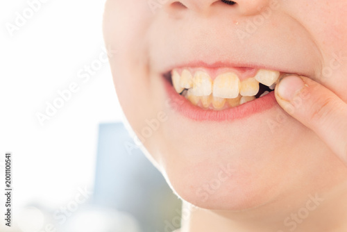 Foto Close up child mouth showing damaged tooth and pointing finger, dental health pr