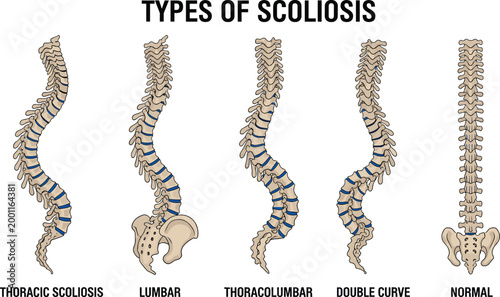 Types of Scoliosis Diagram with Spine Curvature Variations, Thoracic, Lumbar, Thoracolumbar, Double Curve and Normal Spine Comparison Vector Illustration