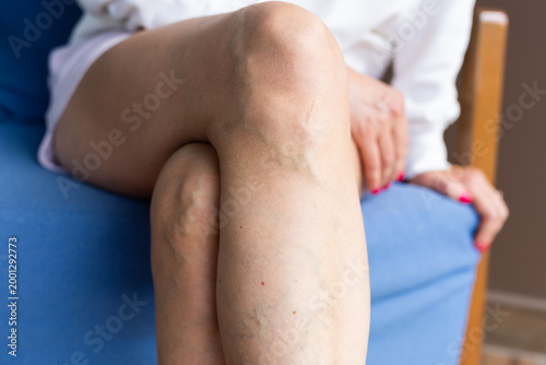 Tableau sur toile Close-up of a woman's legs with varicose veins while sitting indoors