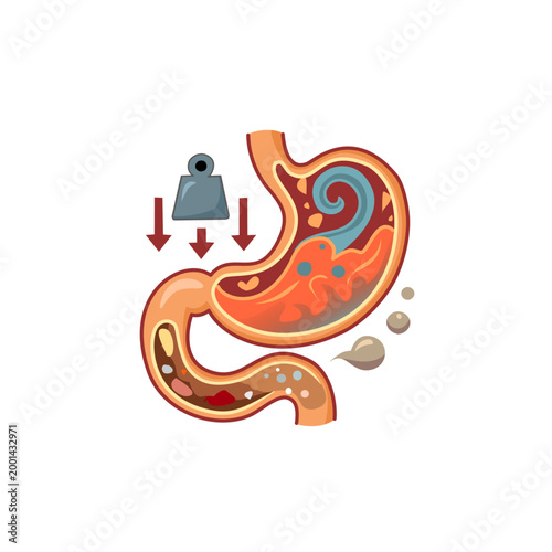 Dyspepsia Concept Illustration, Digestive Problem and Stomach Discomfort
