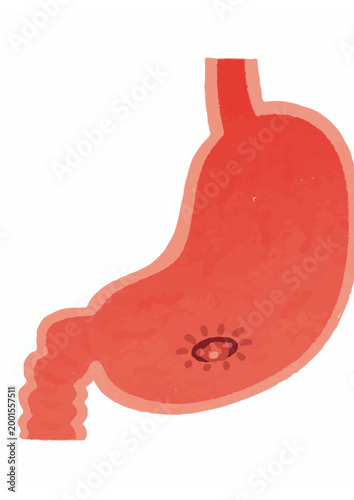 Stomach ulcer illustration showing inflammation inside organ wall for medical condition.