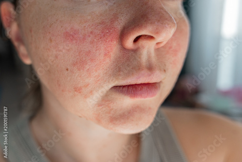 Close-up of a young womans face with visible skin irritation and redness. Inflamed, dry, and textured skin. Concept of sensitive skin, allergy, inflammation, and skincare problems