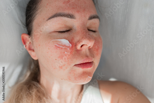 Close-up woman applying cream to red, irritated skin on her cheek after sunburn, cosmetic peeling, or skin damage. Concept of UV exposure, skincare recovery, hydration, dermatological treatment.