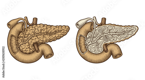 Illustration comparing a healthy pancreas with a diseased pancreas, showing anatomical details and tissue changes.